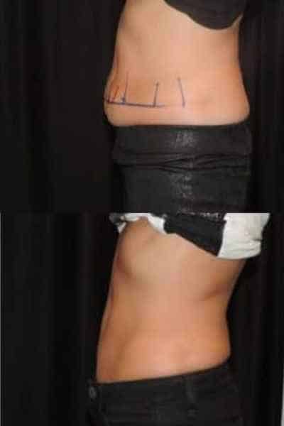 HIEMT Muscle Toning Broxburn