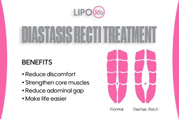 Revolutionising Muscle Repair: The Power of LIPO360 Body Sculpt Post-Injury 5 diastasis recti treatment Broxburn