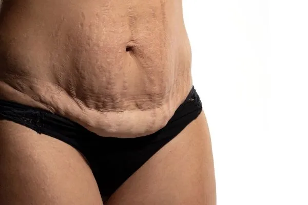 The Science of Skin Tightening 1 The science behind skin tightening Broxburn picture of a woman's sagging skin on the stomach